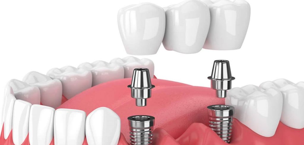 What You Need to Know About Implant Treatment