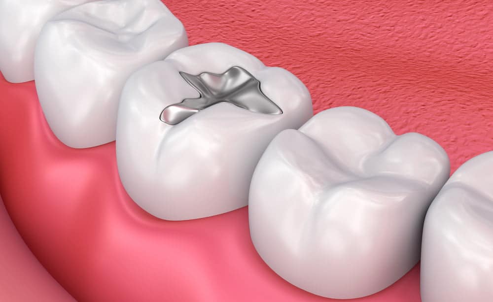 What is a Dental Filling?