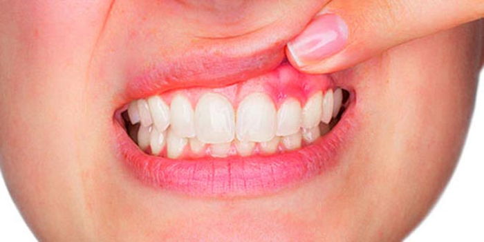 What is a Tooth Abscess? How is it Treated?